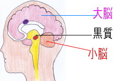 パーキンソン病